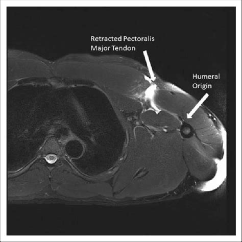 T2 axial MRI image of pectoralis major tear. MRI: magnetic resonance... | Download Scientific ...