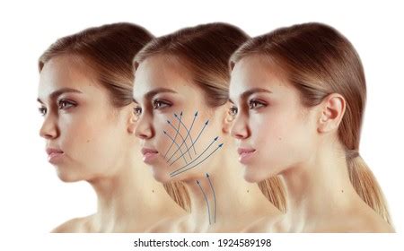 Woman Double Chin Before After Stock Photo 1924589198 | Shutterstock