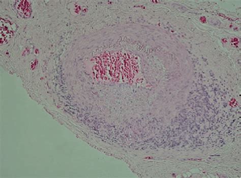 4 Temporal artery biopsy from a patient with giant cell arteritis ...