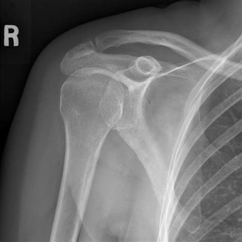 Will The Bone Spur In My Shoulder Cause A Future Rotator Cuff Tear? — Mend