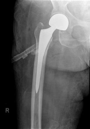 Bipolar Hemiarthroplasty Vs Total Hip Replacement