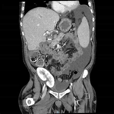 CT-scan 3 months post-transplant showing liver graft, kidney graft in... | Download Scientific ...