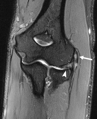 Elbow Imaging in Sport: Sports Imaging Series | Radiology