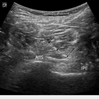 Ultrasound image of PENG block showing lateral to medial insertion of... | Download Scientific ...