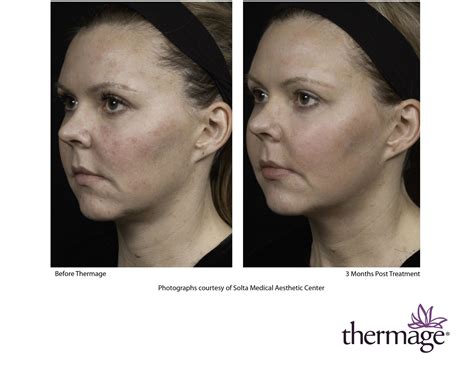 Thermage Skin Tightening - Radiance MedSpa Wheaton