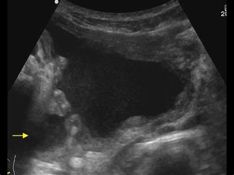 Urinary Tract and male reproductive system | 2.2 Bladder : Case 2.2.3 Miscellaneous bladder and ...