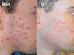 Laser Acne Treatment Side Effects ~ Skin Whitening Advices