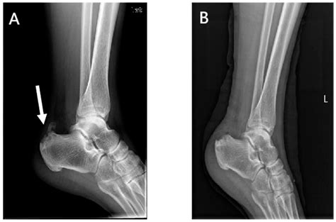 JPM | Free Full-Text | Treatment of Calcific Insertional Achilles Tendinopathy: Knotless ...