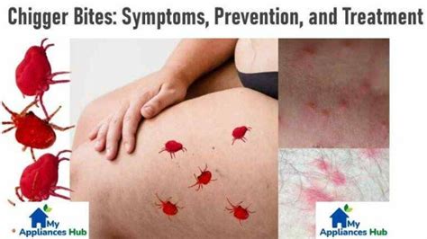 Chiggers 101: Symptoms, Prevention, Treatment, and Control of Chigger Bites