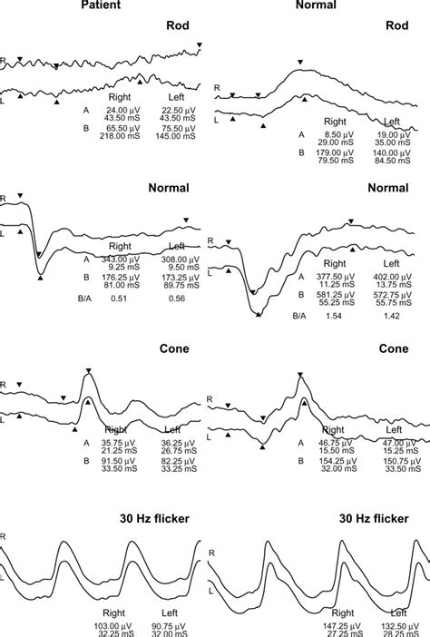 Recording of ERG from the patient. Notes: Whereas both the cone ERG and... | Download Scientific ...