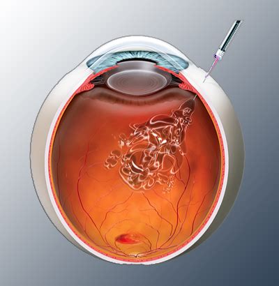 Intravitreal Eye Injection | An Innovative A.M.D. Treatment