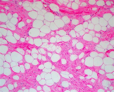 Lipoma pathophysiology - wikidoc