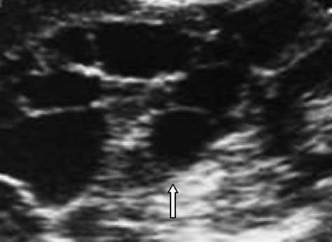 Isolated Primary Splenic Hydatid Cyst in a Six-year-old Boy: A Case ...