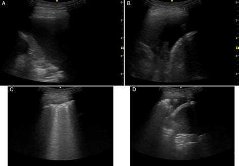 Pleural ultrasound images of an anechoic pleural effusion at mid... | Download Scientific Diagram