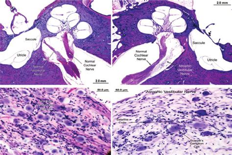 Temporal bone histopathology with salient features labeled. Left panels... | Download Scientific ...