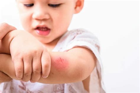 How To Deal With Minor Injuries In Children | Childhealthy