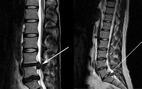 Cauda equina syndrome - wikidoc