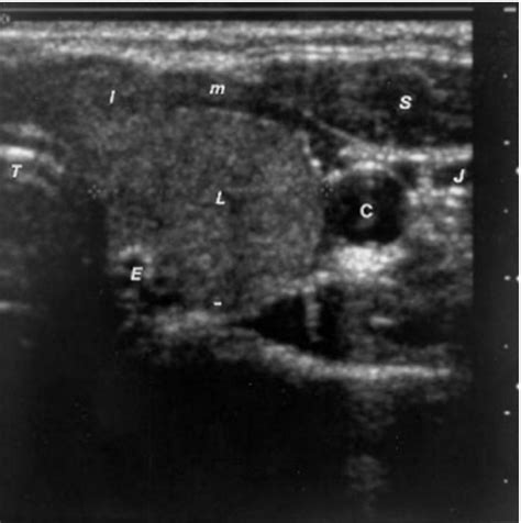 Ultrasonography of the Thyroid - Endotext - NCBI Bookshelf