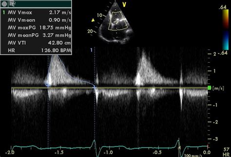 Mitral stenosis echocardiography - wikidoc