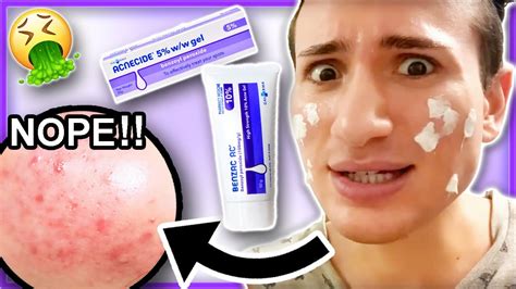 I tried BENZOYL PEROXIDE Acnecide for ONE WEEK!! (it caused a rash?!) - YouTube