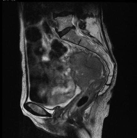 Malignant peritoneal mesothelioma | Radiology Reference Article | Radiopaedia.org