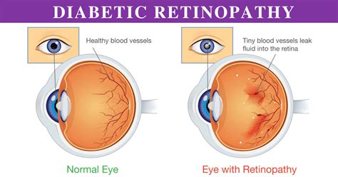 Diabetic Retinopathy Stages: How it's treated? - sriramakrishnahospital