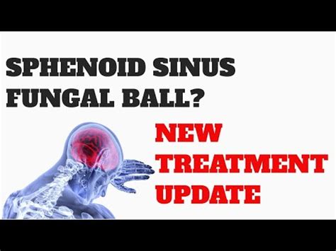 SPHENOID SINUS Fungal Ball | TREATMENT UPDATE - YouTube