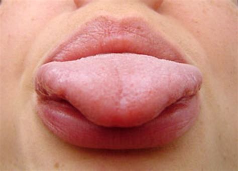 Oral Herpes Tongue images