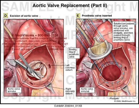 Valve Replacement Surgery: Aortic Valve Replacement Surgery Wiki