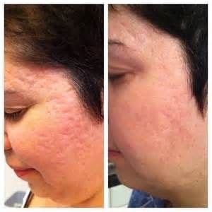 acne pock marks reduced with Rodan+Fields AMP MD Roller in 10 days! Rodan Fields Skin Care ...