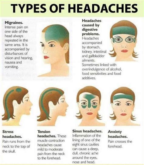 Migraine Remedies That Really Work | Migraines remedies, Headache types, Health remedies