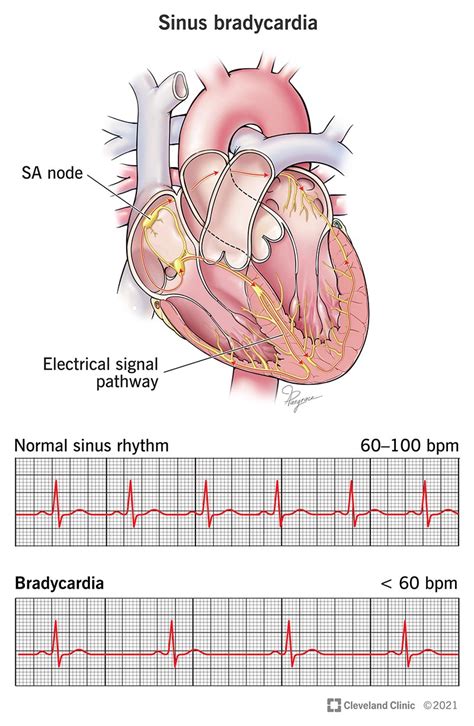 Sinus Bradycardia: Causes, Symptoms & Treatment