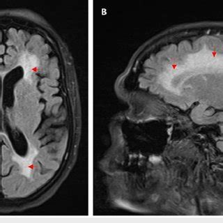 Brain MRI showing extensive chronic microangiopathic changes (A) Axial ...