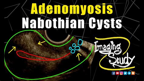 Adenomyosis With Nabothian Cysts Ultrasound Tvs Case 255 Youtube | Free Download Nude Photo Gallery