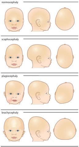 A guide to different head shapes | Plagiocephaly | Baby head shape ...