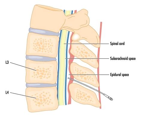 Spinal Block Vs Epidural