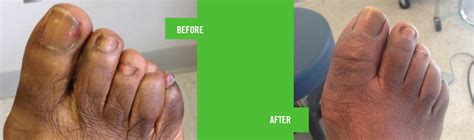 Before and After - European Foot & Ankle Clinic