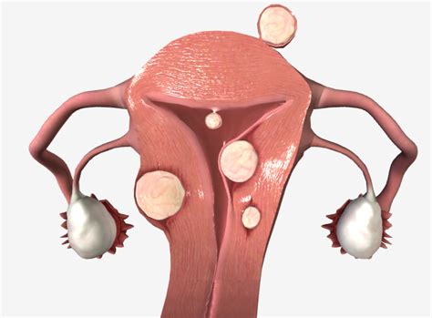 Abnormal Uterine Bleeding | Concise Medical Knowledge