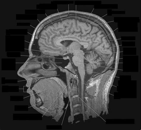 Sagittal Brain MRI Diagram | Quizlet