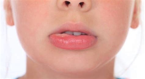 How to Get Rid Of a Mucous Cyst or Mococele? (Mucous Cyst Lip Home ...