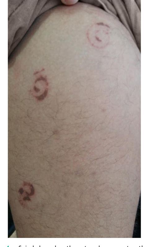 Figure 1 from Millipede accident with unusual dermatological lesion ...