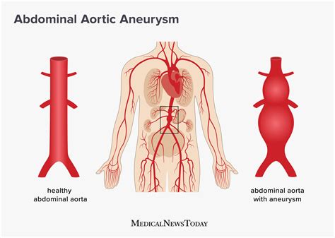 Abdominal aortic aneurysm: Screening, treatment, and symptoms