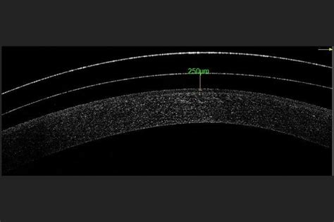 Anterior Segment-OCT Improves Specialty Contact Lens Fitting Experience - Optometry Advisor