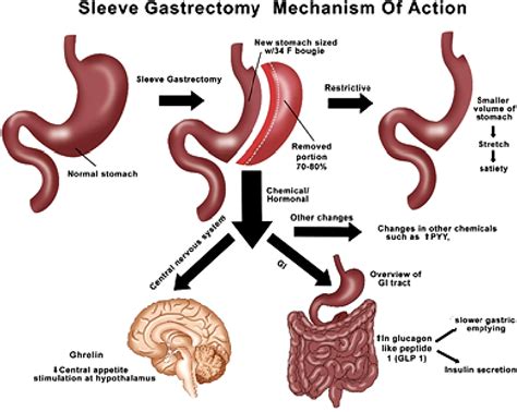 Laparoscopic Gastrectomy For Gastric Cancer Youtube - vrogue.co