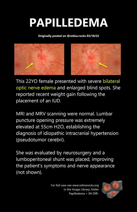 Optic Neuritis Vs Papilledema