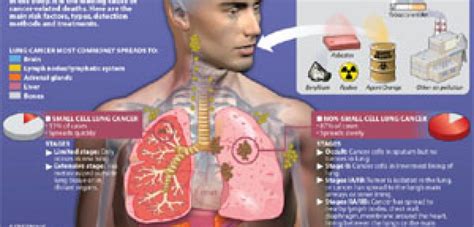 Causes of Lung Cancer | Only Infographic