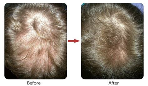 Hair Restoration Before and After Gallery - Laser Cap Me