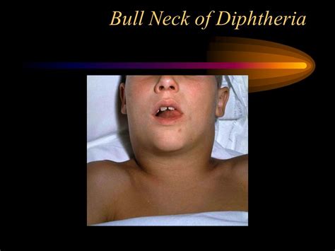 Diphtheria Bull Neck