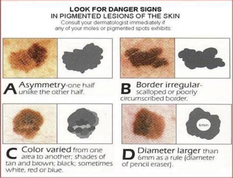 Malignant Melanoma Foot