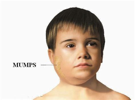 NATURAL HOME REMEDIES FOR CURING MUMPS - Natural Fitness Tips